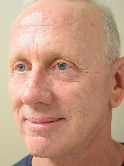 Facelift Before & After Gallery - Patient 126034 - Image 8