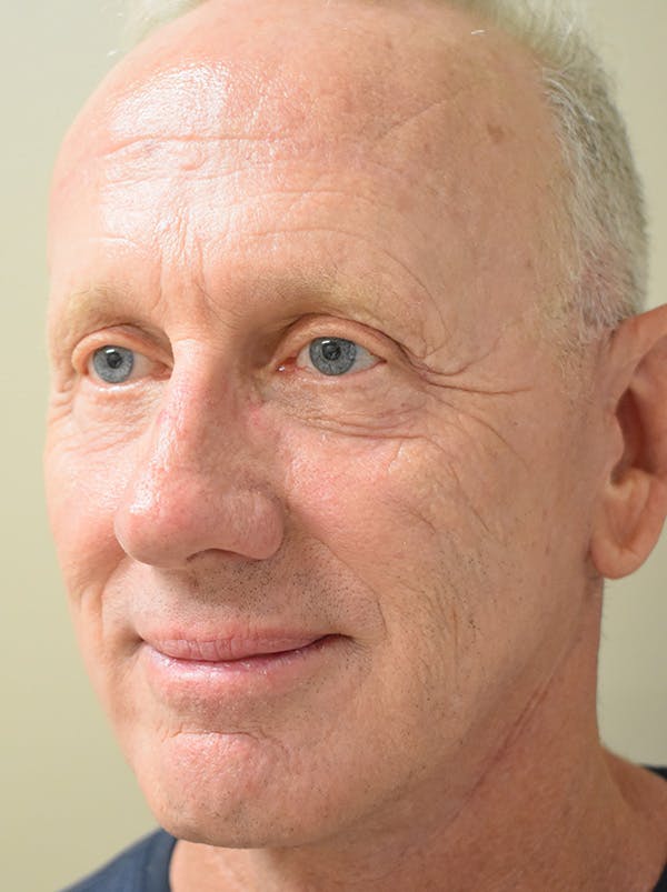 Facelift Before & After Gallery - Patient 126034 - Image 8