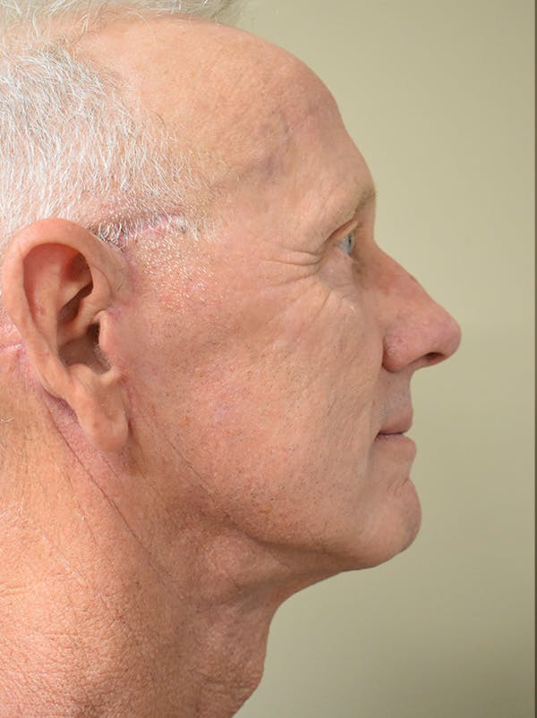 Facelift Before & After Gallery - Patient 126034 - Image 6