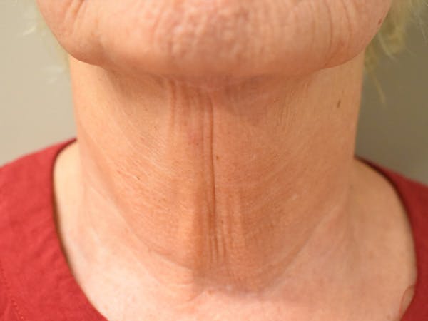 Chin Tuck Before & After Gallery - Patient 330564 - Image 6