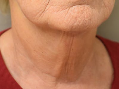Chin Tuck Before & After Gallery - Patient 330564 - Image 4