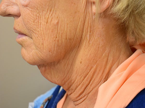 Chin Tuck Before & After Gallery - Patient 330564 - Image 7