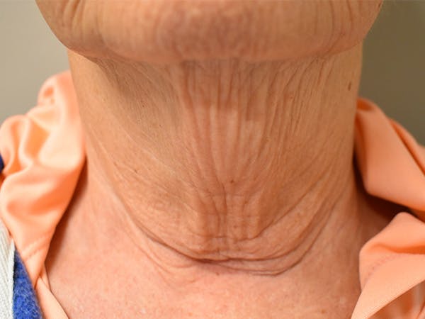 Chin Tuck Before & After Gallery - Patient 330564 - Image 5