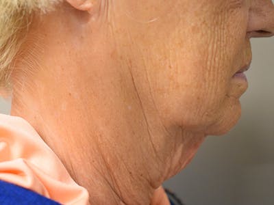 Chin Tuck Before & After Gallery - Patient 330564 - Image 1