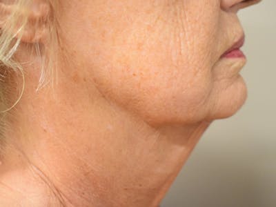 Chin Tuck Before & After Gallery - Patient 330564 - Image 2