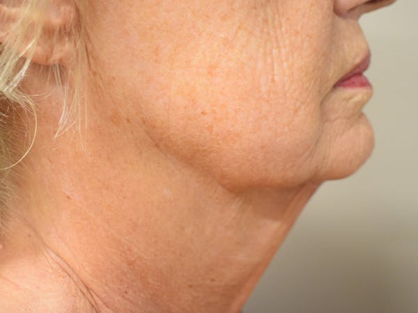 Chin Tuck Before & After Gallery - Patient 330564 - Image 2