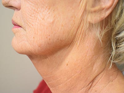 Chin Tuck Before & After Gallery - Patient 330564 - Image 8