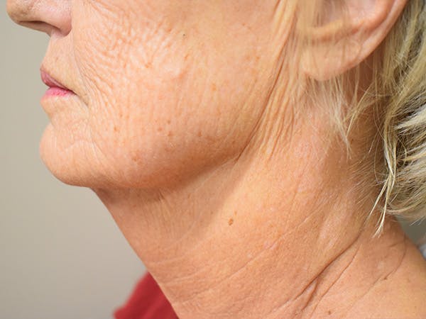 Chin Tuck Before & After Gallery - Patient 330564 - Image 8