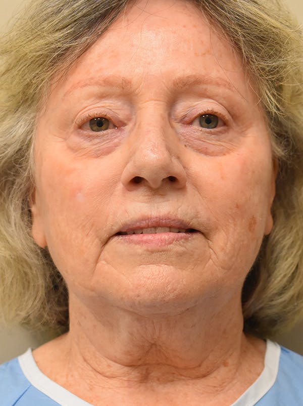 Co2 Laser Resurfacing Before & After Gallery - Patient 694518 - Image 1