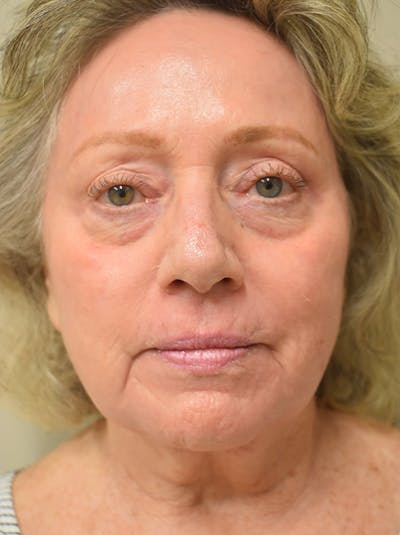 Co2 Laser Resurfacing Before & After Gallery - Patient 694518 - Image 2