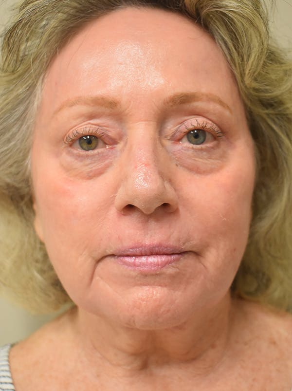 Co2 Laser Resurfacing Before & After Gallery - Patient 694518 - Image 2
