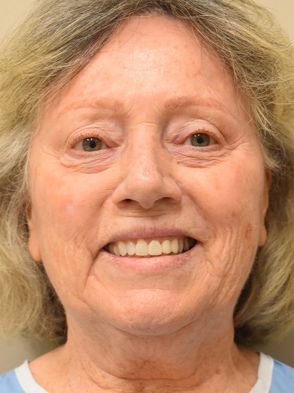 Co2 Laser Resurfacing Before & After Gallery - Patient 694518 - Image 3