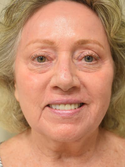 Co2 Laser Resurfacing Before & After Gallery - Patient 694518 - Image 4