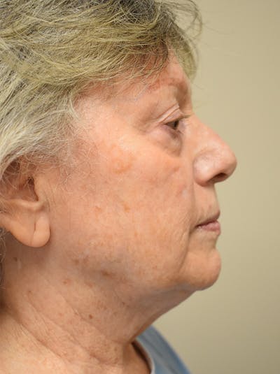 Chin Tuck Before & After Gallery - Patient 108023 - Image 1