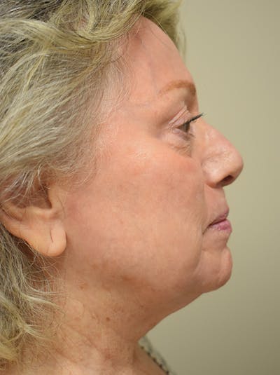 Co2 Laser Resurfacing Before & After Gallery - Patient 694518 - Image 6