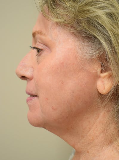 Co2 Laser Resurfacing Before & After Gallery - Patient 694518 - Image 8