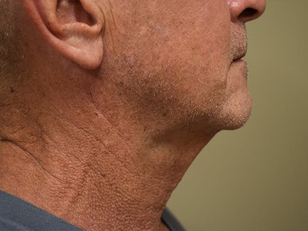 Chin Tuck Before & After Gallery - Patient 309224 - Image 2