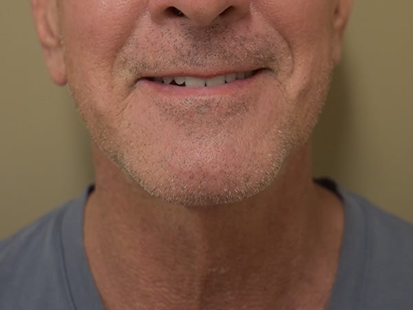 Chin Tuck Before & After Gallery - Patient 309224 - Image 4