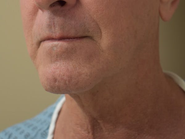 Chin Tuck Before & After Gallery - Patient 309224 - Image 5