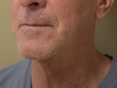 Chin Tuck Before & After Gallery - Patient 309224 - Image 6