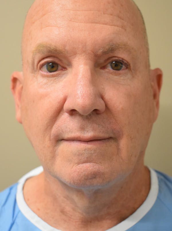 Chin Tuck Before & After Gallery - Patient 410820 - Image 5