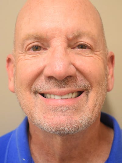 Chin Tuck Before & After Gallery - Patient 410820 - Image 6