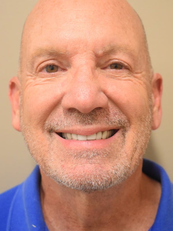 Chin Tuck Before & After Gallery - Patient 410820 - Image 6