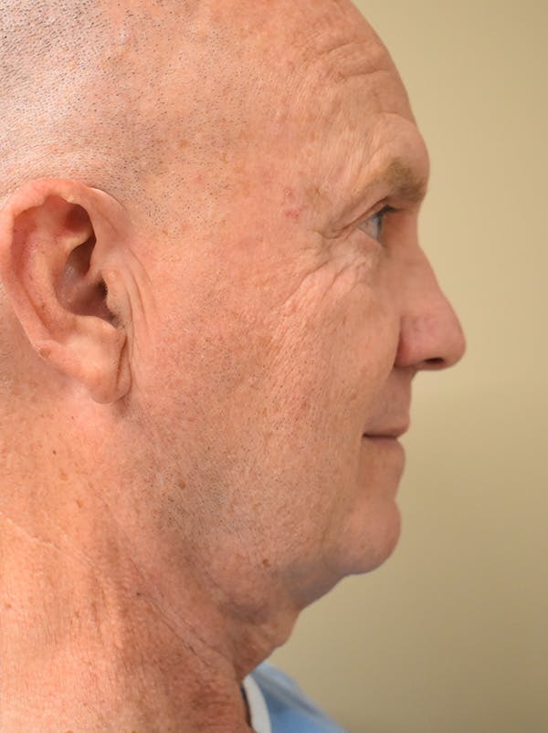 Chin Tuck Before & After Gallery - Patient 410820 - Image 1