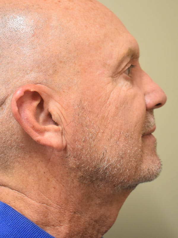 Chin Tuck Before & After Gallery - Patient 410820 - Image 2