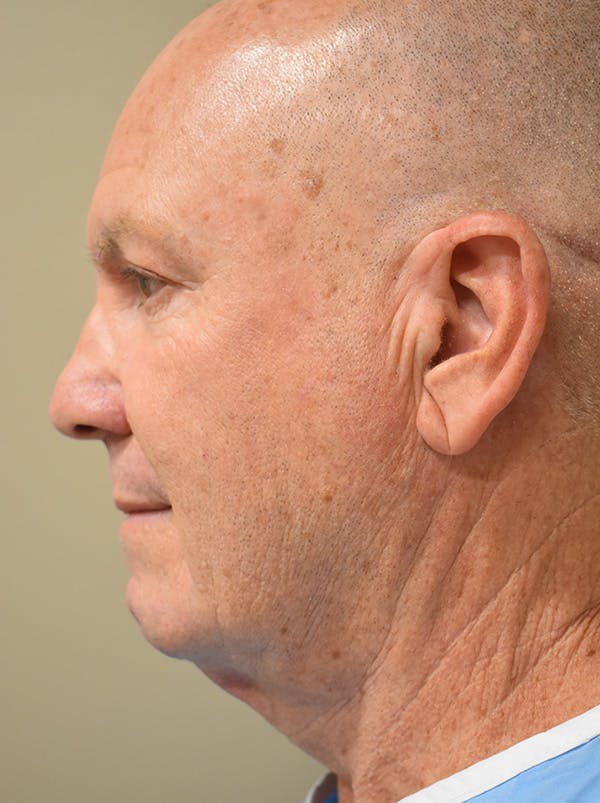 Chin Tuck Before & After Gallery - Patient 410820 - Image 3