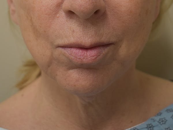 Chin Tuck Before & After Gallery - Patient 263629 - Image 5