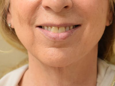 Chin Tuck Before & After Gallery - Patient 263629 - Image 6