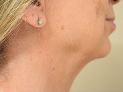 Chin Tuck Before & After Gallery - Patient 263629 - Image 2