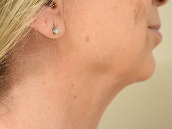 Chin Tuck Before & After Gallery - Patient 263629 - Image 2