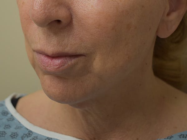 Chin Tuck Before & After Gallery - Patient 263629 - Image 3