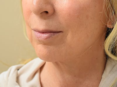 Chin Tuck Before & After Gallery - Patient 263629 - Image 4