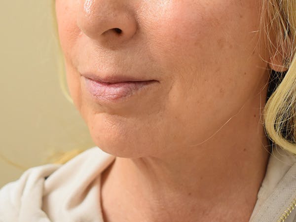 Chin Tuck Before & After Gallery - Patient 263629 - Image 4