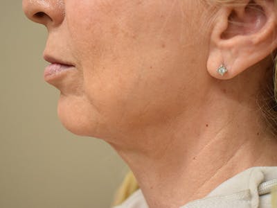 Chin Tuck Before & After Gallery - Patient 263629 - Image 8