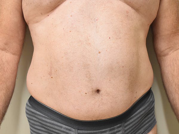 Liposuction Before & After Gallery - Patient 109376 - Image 1