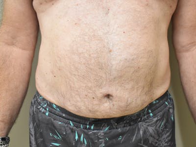 Liposuction Before & After Gallery - Patient 109376 - Image 2