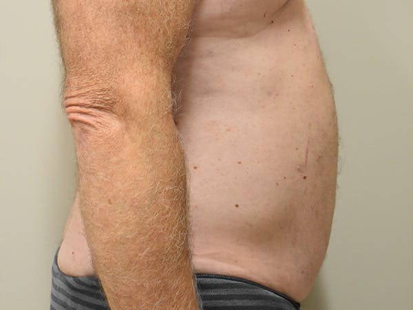 Liposuction Before & After Gallery - Patient 109376 - Image 3