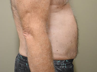 Liposuction Before & After Gallery - Patient 109376 - Image 4