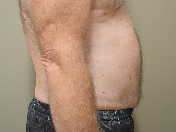 Liposuction Before & After Gallery - Patient 109376 - Image 4