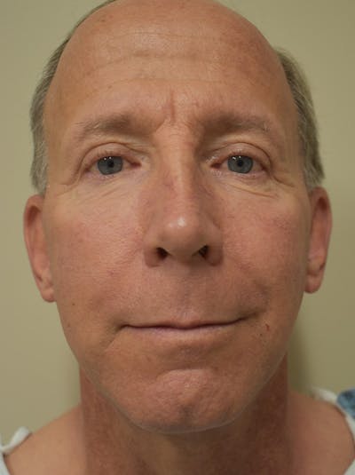 Facelift Before & After Gallery - Patient 324287 - Image 1