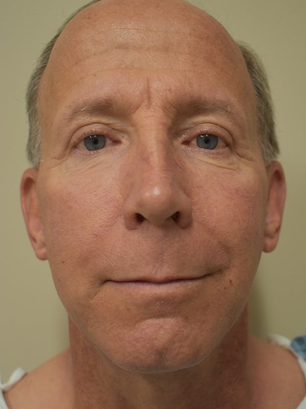 Facelift Before & After Gallery - Patient 324287 - Image 1