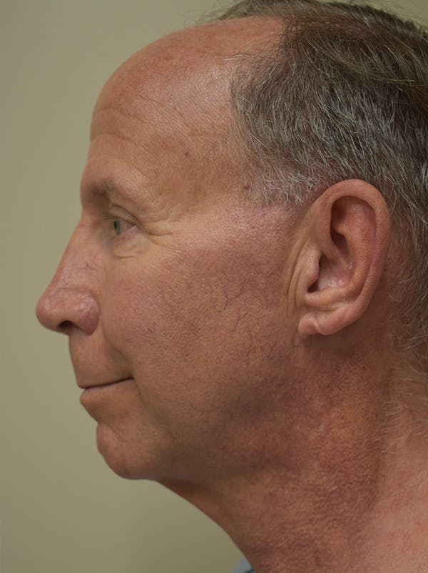 Facelift Before & After Gallery - Patient 324287 - Image 5