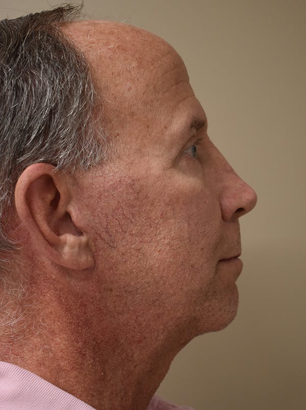 Facelift Before & After Gallery - Patient 324287 - Image 8