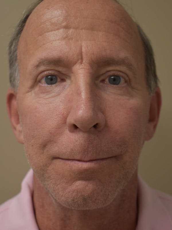 Facelift Before & After Gallery - Patient 324287 - Image 2