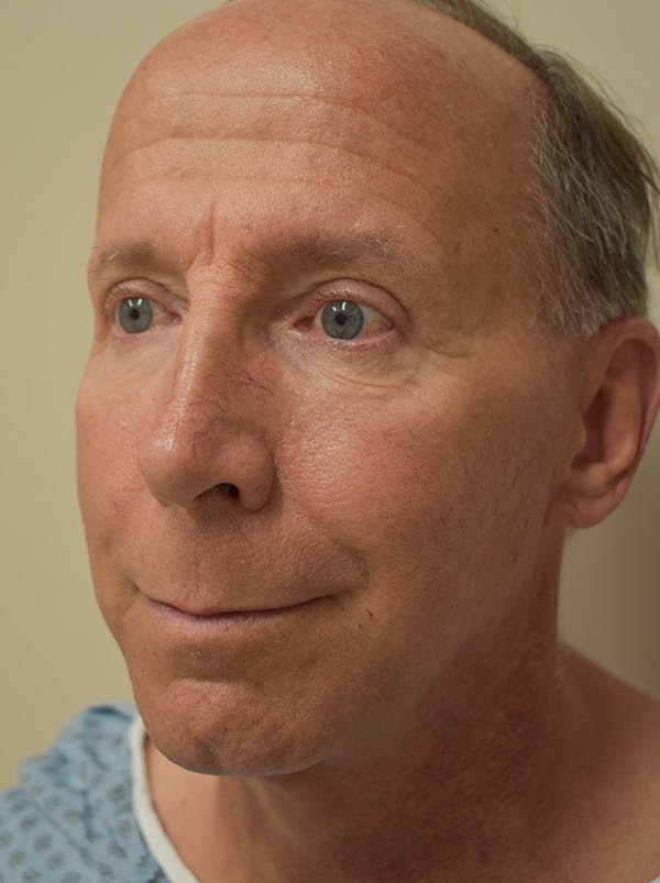 Facelift Before & After Gallery - Patient 324287 - Image 3