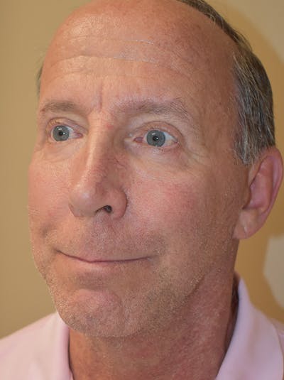 Facelift Before & After Gallery - Patient 324287 - Image 4